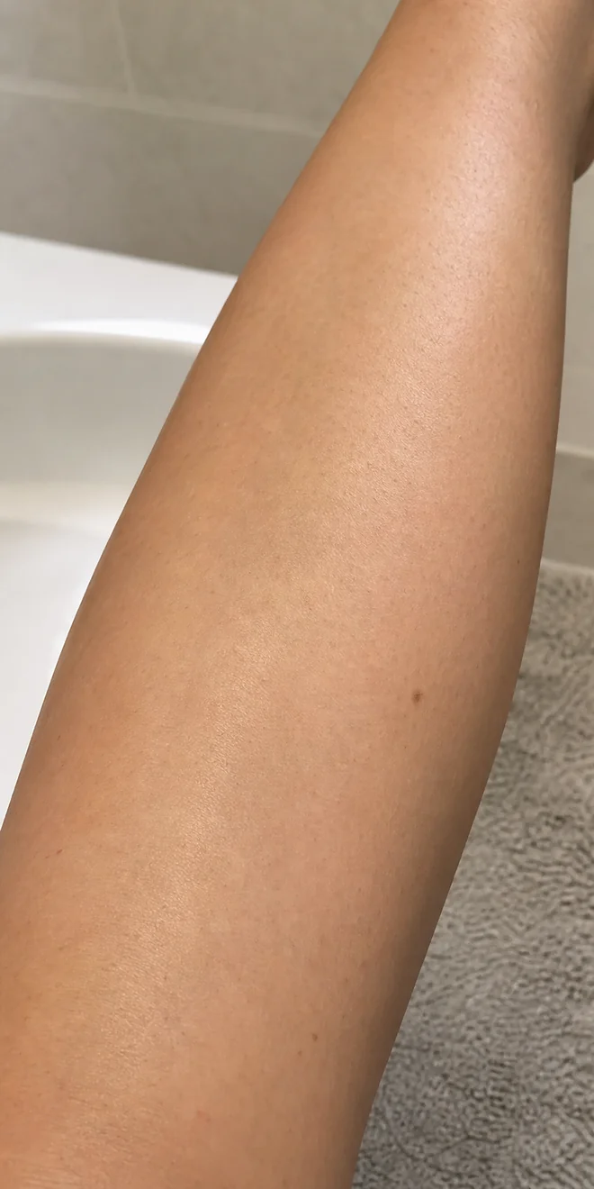 Vùng chân sau liệu trình sử dụng MLay IPL