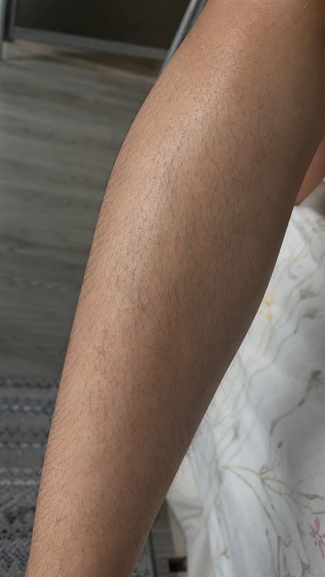 Vùng chân trước khi sử dụng MLay IPL