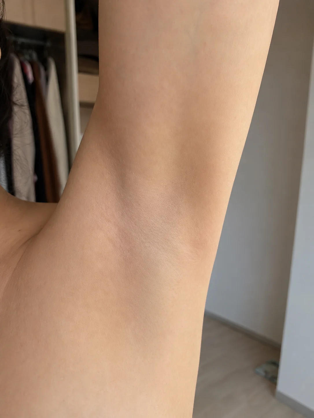 Vùng nách sau liệu trình sử dụng MLay IPL