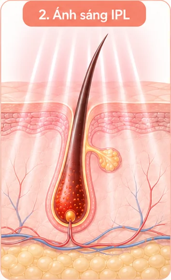 Bước 2: Ánh sáng IPL tác động